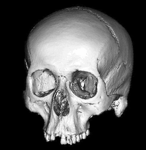 CT of human skull
